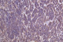 Immunohistochemistry of paraffin-embedded human pancreatic cancer using CAC07636 at dilution of 1:100