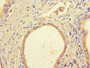 Immunohistochemistry of paraffin-embedded human prostate cancer using CAC07649 at dilution of 1:100