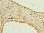 Immunohistochemistry of paraffin-embedded human prostate cancer using CAC07651 at dilution of 1:100