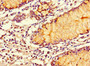 Immunohistochemistry of paraffin-embedded human colon cancer using CAC07681 at dilution of 1:100