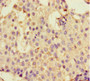 Immunohistochemistry of paraffin-embedded human breast cancer using CAC07685 at dilution of 1:100