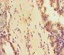 Immunohistochemistry of paraffin-embedded human lung cancer using CAC07685 at dilution of 1:100