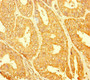 Immunohistochemistry of paraffin-embedded human endometrial cancer using CAC07689 at dilution of 1:100