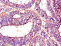 Immunohistochemistry of paraffin-embedded human endometrial cancer using CAC07718 at dilution of 1:100