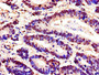 Immunohistochemistry of paraffin-embedded human colon cancer using CAC07726 at dilution of 1:100