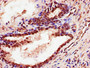 Immunohistochemistry of paraffin-embedded human prostate cancer using CAC07726 at dilution of 1:100