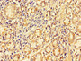 Immunohistochemistry of paraffin-embedded human gastric cancer using CAC07753 at dilution of 1:100