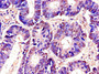 Immunohistochemistry of paraffin-embedded human colon cancer using CAC07754 at dilution of 1:100