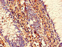 Immunohistochemistry of paraffin-embedded human colon cancer using CAC07809 at dilution of 1:100