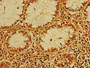 Immunohistochemistry of paraffin-embedded human colon cancer using CAC07817 at dilution of 1:100