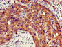 Immunohistochemistry of paraffin-embedded human pancreatic cancer using CAC07824 at dilution of 1:100