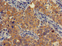 Immunohistochemistry of paraffin-embedded human pancreatic cancer using CAC07839 at dilution of 1:100