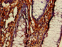 IHC image diluted at 1:400 and staining in paraffin-embedded human colon cancer performed on a Leica BondTM system. After dewaxing and hydration, antigen retrieval was mediated by high pressure in a citrate buffer (pH 6.0). Section was blocked with 10% normal goat serum 30min at RT. Then primary antibody (1% BSA) was incubated at 4°C overnight. The primary is detected by a biotinylated secondary antibody and visualized using an HRP conjugated SP system.