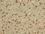 Immunohistochemistry of paraffin-embedded human glioma using CAC07931 at dilution of 1:100