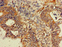 Immunohistochemistry of paraffin-embedded human colon cancer using CAC07940 at dilution of 1:100