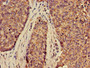 Immunohistochemistry of paraffin-embedded human ovarian cancer using CAC07944 at dilution of 1:100