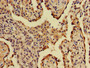 Immunohistochemistry of paraffin-embedded human lung cancer using CAC07963 at dilution of 1:100