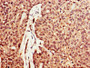 IHC image diluted at 1:600 and staining in paraffin-embedded human ovarian cancer performed on a Leica BondTM system. After dewaxing and hydration, antigen retrieval was mediated by high pressure in a citrate buffer (pH 6.0). Section was blocked with 10% normal goat serum 30min at RT. Then primary antibody (1% BSA) was incubated at 4°C overnight. The primary is detected by a biotinylated secondary antibody and visualized using an HRP conjugated SP system.