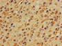 IHC image diluted at 1:400 and staining in paraffin-embedded human glioma performed on a Leica BondTM system. After dewaxing and hydration, antigen retrieval was mediated by high pressure in a citrate buffer (pH 6.0). Section was blocked with 10% normal goat serum 30min at RT. Then primary antibody (1% BSA) was incubated at 4°C overnight. The primary is detected by a biotinylated secondary antibody and visualized using an HRP conjugated SP system.