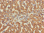 Immunohistochemistry of paraffin-embedded human liver cancer using CAC08040 at dilution of 1:100