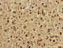 Immunohistochemistry of paraffin-embedded human glioma using CAC08049 at dilution of 1:100