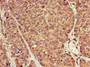 Immunohistochemistry of paraffin-embedded human ovarian cancer using CAC08056 at dilution of 1:100