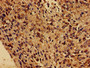 Immunohistochemistry of paraffin-embedded human glioma using CAC08062 at dilution of 1:100