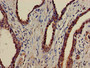 Immunohistochemistry of paraffin-embedded human prostate cancer using CAC08073 at dilution of 1:100