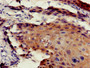 Immunohistochemistry of paraffin-embedded human cervical cancer using CAC08092 at dilution of 1:100