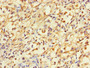 Immunohistochemistry of paraffin-embedded human gastric cancer using CAC08207 at dilution of 1:100