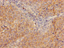 Immunohistochemistry of paraffin-embedded human cervical cancer using CAC08209 at dilution of 1:100