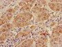 Immunohistochemistry of paraffin-embedded human liver cancer using CAC08211 at dilution of 1:100