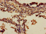 Immunohistochemistry of paraffin-embedded human lung cancer using CAC08213 at dilution of 1:100