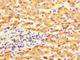 IHC image diluted at 1:400 and staining in paraffin-embedded human liver cancer performed on a Leica BondTM system. After dewaxing and hydration, antigen retrieval was mediated by high pressure in a citrate buffer (pH 6.0). Section was blocked with 10% normal goat serum 30min at RT. Then primary antibody (1% BSA) was incubated at 4°C overnight. The primary is detected by a biotinylated secondary antibody and visualized using an HRP conjugated SP system.