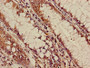 Immunohistochemistry of paraffin-embedded human colon cancer using CAC08226 at dilution of 1:100