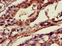 Immunohistochemistry of paraffin-embedded human gastric cancer using CAC08231 at dilution of 1:100