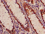 Immunohistochemistry of paraffin-embedded human colon cancer using CAC08236 at dilution of 1:100