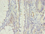 Immunohistochemistry of paraffin-embedded human colon cancer using CAC08237 at dilution of 1:100