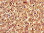 Immunohistochemistry of paraffin-embedded human liver cancer using CAC08248 at dilution of 1:100