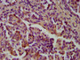 IHC image diluted at 1:400 and staining in paraffin-embedded human lung cancer performed on a Leica BondTM system. After dewaxing and hydration, antigen retrieval was mediated by high pressure in a citrate buffer (pH 6.0). Section was blocked with 10% normal goat serum 30min at RT. Then primary antibody (1% BSA) was incubated at 4°C overnight. The primary is detected by a biotinylated secondary antibody and visualized using an HRP conjugated SP system.