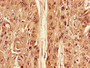 Immunohistochemistry of paraffin-embedded human cervical cancer using CAC08251 at dilution of 1:100