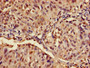 Immunohistochemistry of paraffin-embedded human lung cancer using CAC08255 at dilution of 1:100