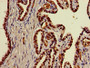 Immunohistochemistry of paraffin-embedded human prostate cancer using CAC08265 at dilution of 1:100