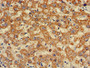 Immunohistochemistry of paraffin-embedded human liver cancer using CAC08273 at dilution of 1:100