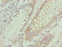 Immunohistochemistry of paraffin-embedded human colon cancer using CAC08295 at dilution of 1:100