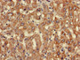 Immunohistochemistry of paraffin-embedded human liver cancer using CAC08313 at dilution of 1:100
