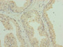Immunohistochemistry of paraffin-embedded human prostate cancer using CAC08318 at dilution of 1:100