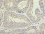 Immunohistochemistry of paraffin-embedded human endometrial cancer using CAC08319 at dilution of 1:100
