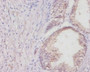 Immunohistochemistry of paraffin-embedded human colon cancer using CAC08324 at dilution of 1:20
