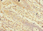 Immunohistochemistry of paraffin-embedded human colon cancer using CAC08329 at dilution of 1:100